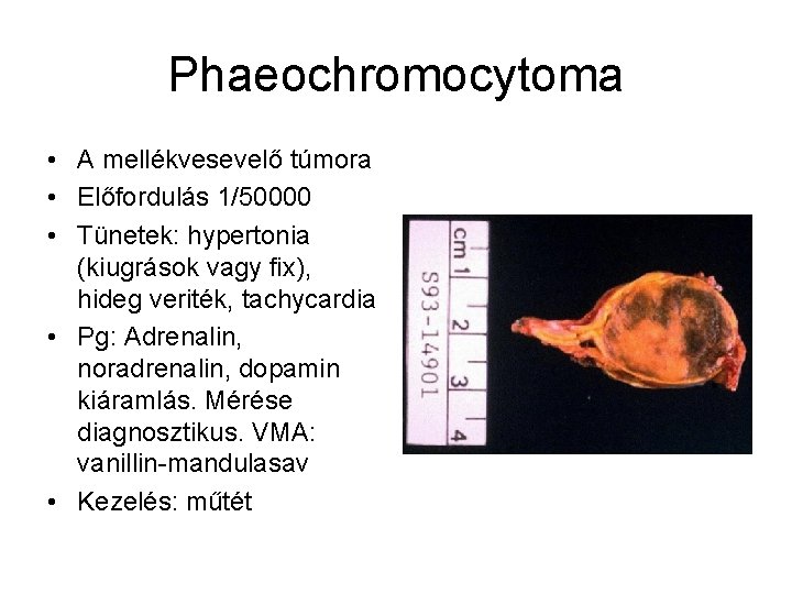 Phaeochromocytoma • A mellékvesevelő túmora • Előfordulás 1/50000 • Tünetek: hypertonia (kiugrások vagy fix),