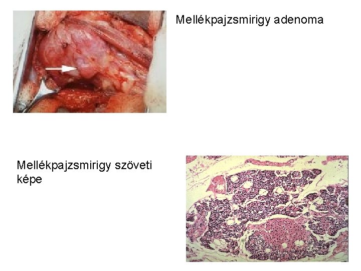 Mellékpajzsmirigy adenoma Mellékpajzsmirigy szöveti képe 