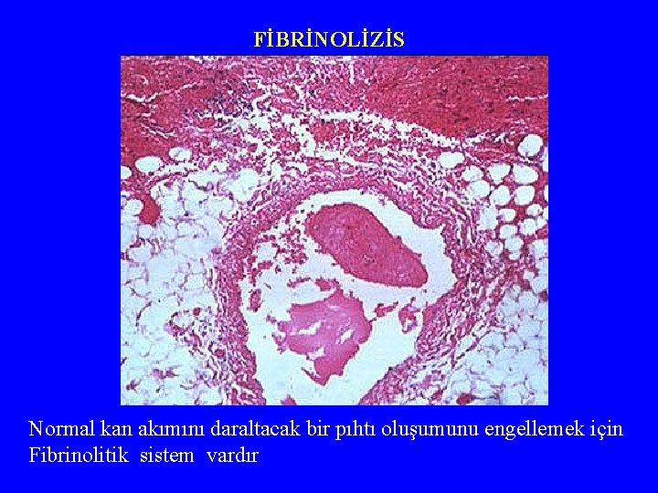 FİBRİNOLİZİS Normal kan akımını daraltacak bir pıhtı oluşumunu engellemek için Fibrinolitik sistem vardır 