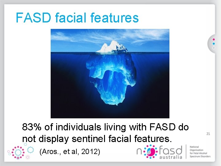 FASD facial features 83% of individuals living with FASD do not display sentinel facial