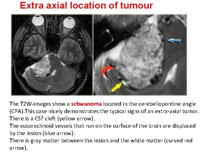 Extra axial location of tumour The T 2 W-images show a schwanoma located in Extra axial location of tumour The T 2 W-images show a schwanoma located in