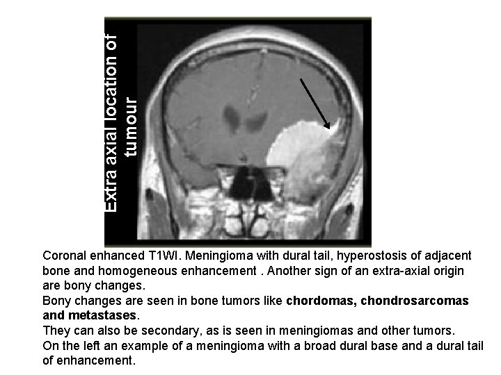 Extra axial location of tumour Coronal enhanced T 1 WI. Meningioma with dural tail,