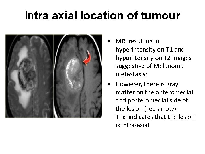 Intra axial location of tumour • MRI resulting in hyperintensity on T 1 and