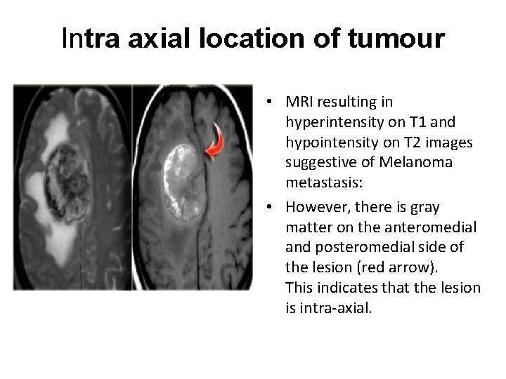 Intra axial location of tumour • MRI resulting in hyperintensity on T 1 and Intra axial location of tumour • MRI resulting in hyperintensity on T 1 and