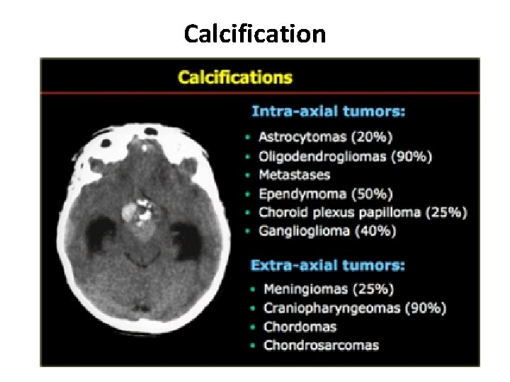 Calcification Calcification