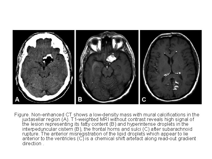 Figure. Non-enhanced CT shows a low-density mass with mural calcifications in the juxtasellar region