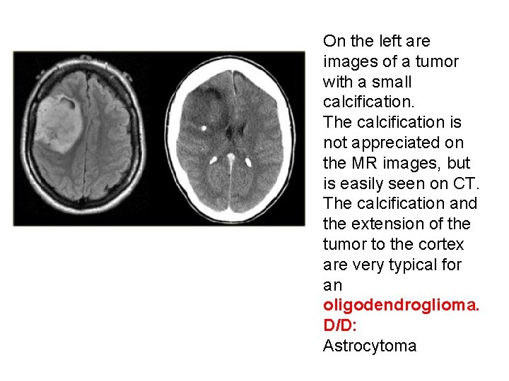 On the left are images of a tumor with a small calcification. The calcification