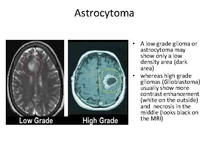 Astrocytoma • A low grade glioma or astrocytoma may show only a low density