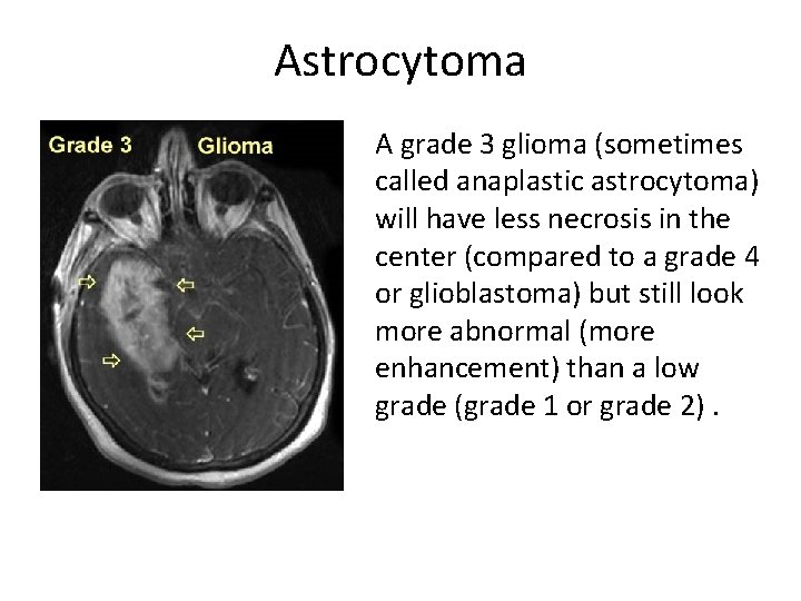 Astrocytoma A grade 3 glioma (sometimes called anaplastic astrocytoma) will have less necrosis in