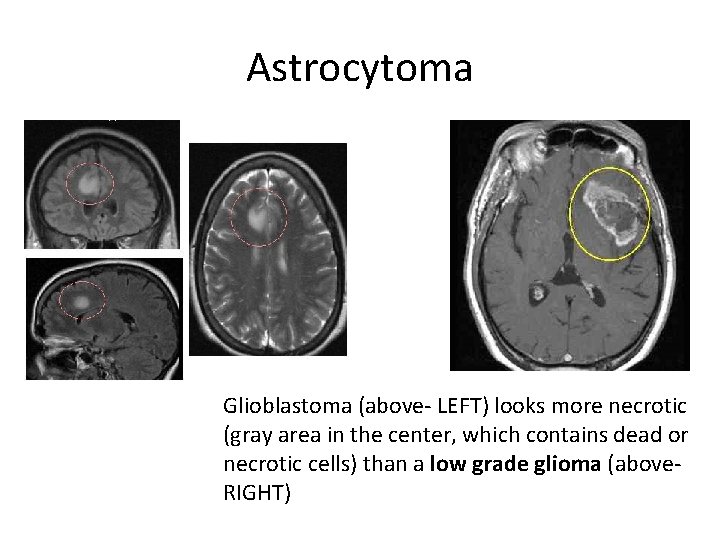 Astrocytoma Glioblastoma (above- LEFT) looks more necrotic (gray area in the center, which contains