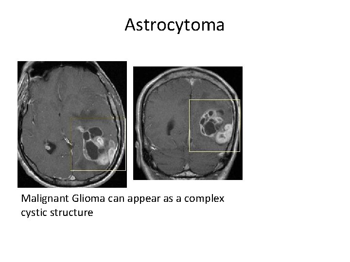 Astrocytoma Malignant Glioma can appear as a complex cystic structure Astrocytoma Malignant Glioma can appear as a complex cystic structure