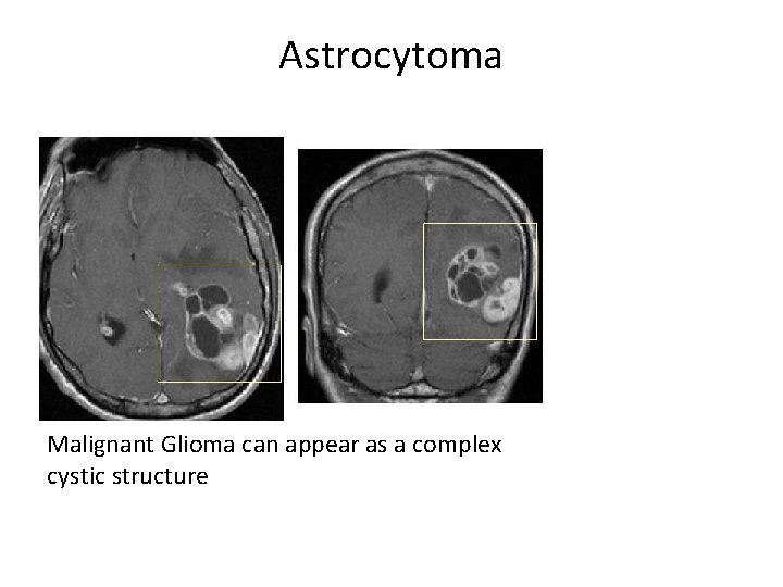 Astrocytoma Malignant Glioma can appear as a complex cystic structure 