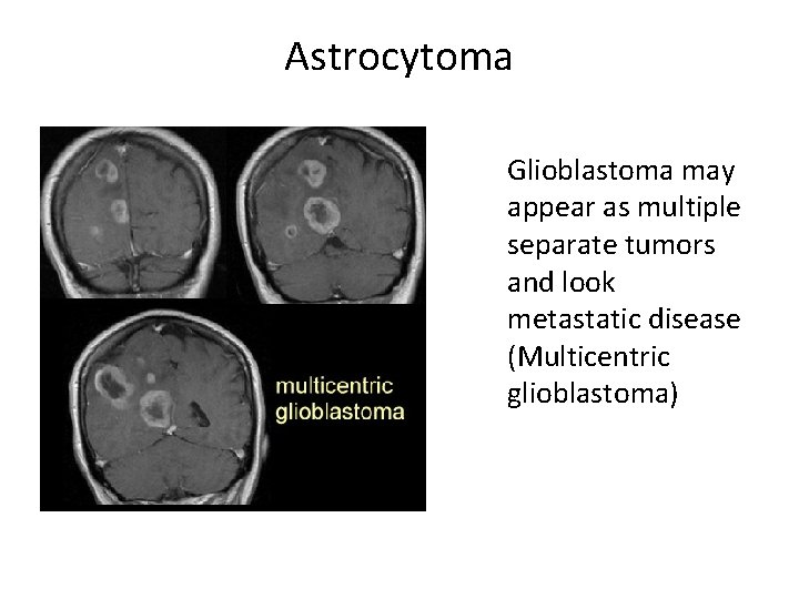 Astrocytoma Glioblastoma may appear as multiple separate tumors and look metastatic disease (Multicentric glioblastoma)