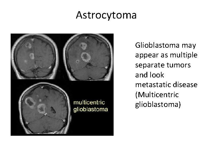 Astrocytoma Glioblastoma may appear as multiple separate tumors and look metastatic disease (Multicentric glioblastoma) Astrocytoma Glioblastoma may appear as multiple separate tumors and look metastatic disease (Multicentric glioblastoma)