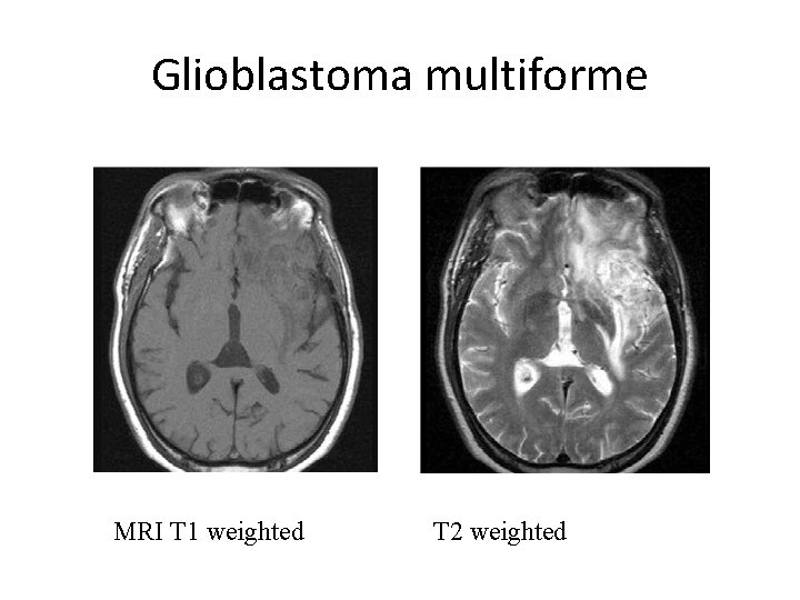 Glioblastoma multiforme MRI T 1 weighted T 2 weighted 