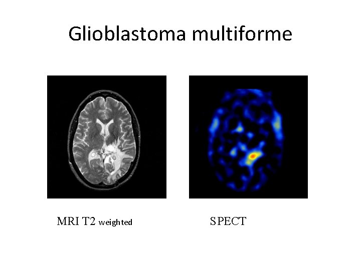 Glioblastoma multiforme MRI T 2 weighted SPECT 