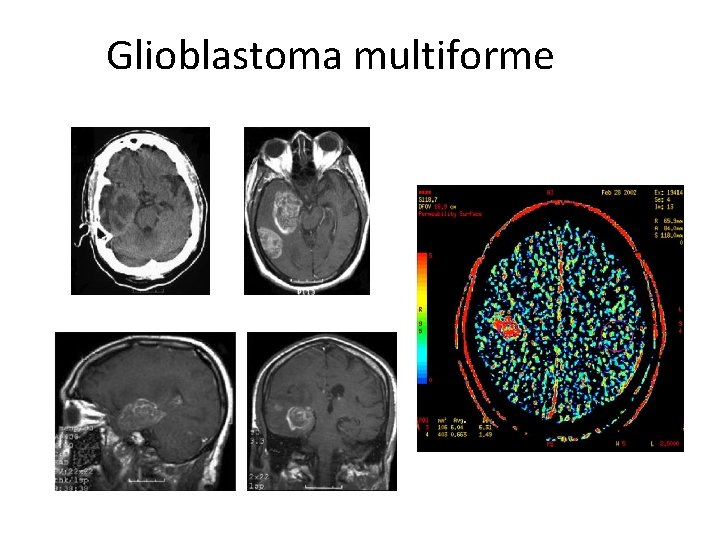 Glioblastoma multiforme 