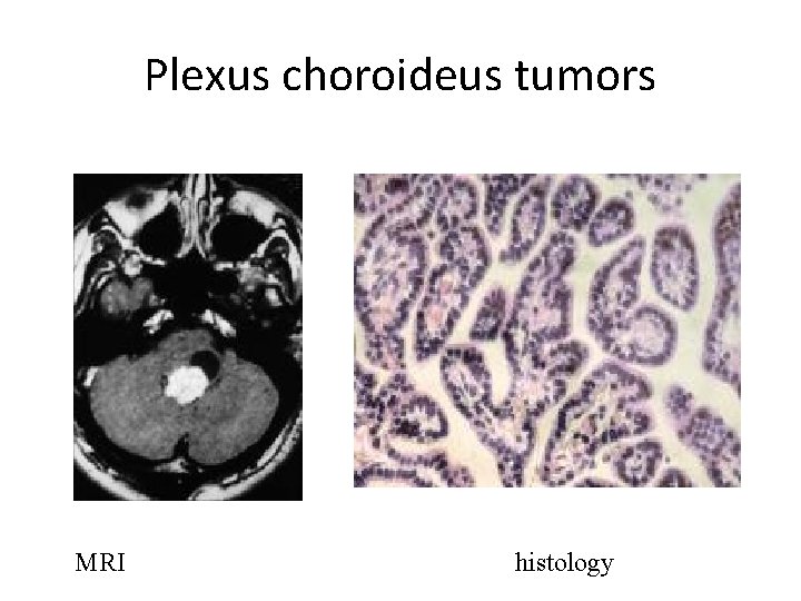 Plexus choroideus tumors MRI histology 
