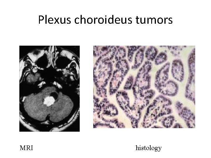 Plexus choroideus tumors MRI histology Plexus choroideus tumors MRI histology