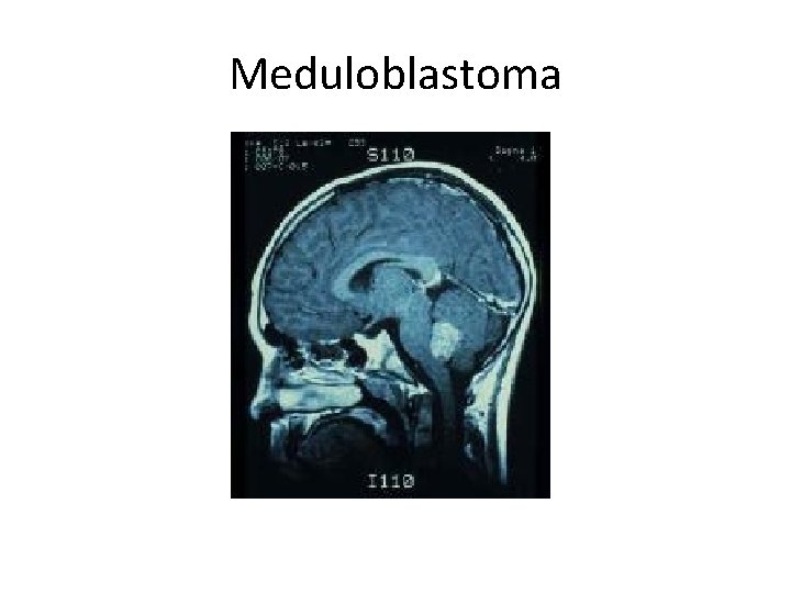 Meduloblastoma 