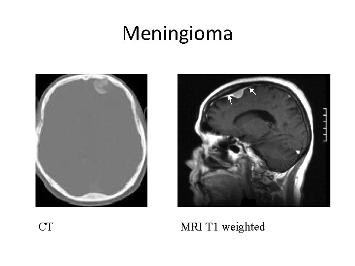 Meningioma CT MRI T 1 weighted 