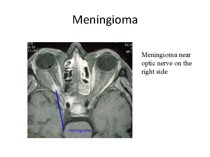 Meningioma near optic nerve on the right side 