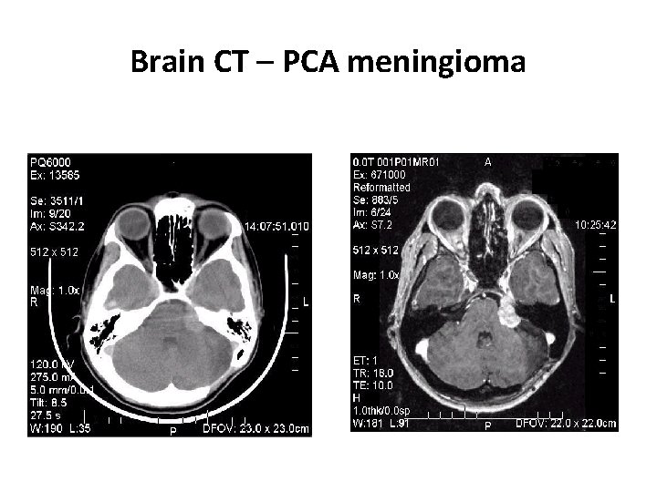 Brain CT – PCA meningioma 