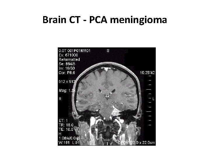 Brain CT - PCA meningioma 