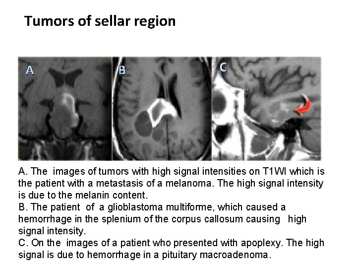 Tumors of sellar region A B C A. The images of tumors with high