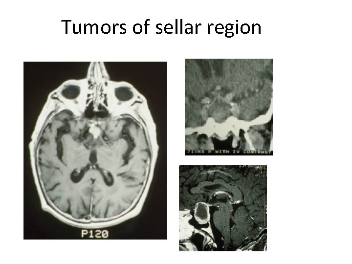 Tumors of sellar region 