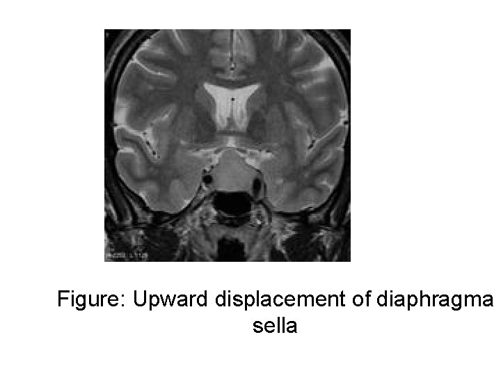 Figure: Upward displacement of diaphragma sella Figure: Upward displacement of diaphragma sella