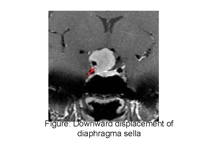 Figure: Downward displacement of diaphragma sella 