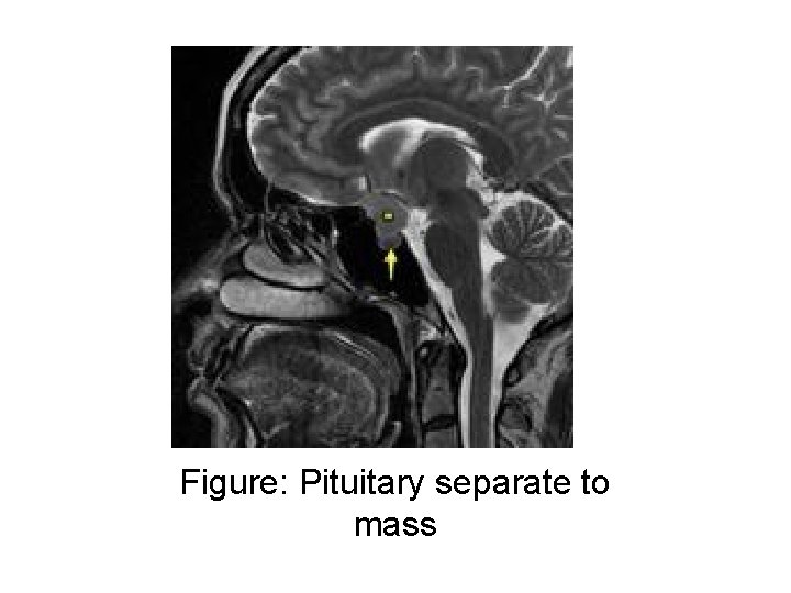 Figure: Pituitary separate to mass 