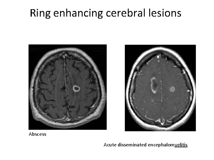 Ring enhancing cerebral lesions Abscess Acute disseminated encephalomyelitis 