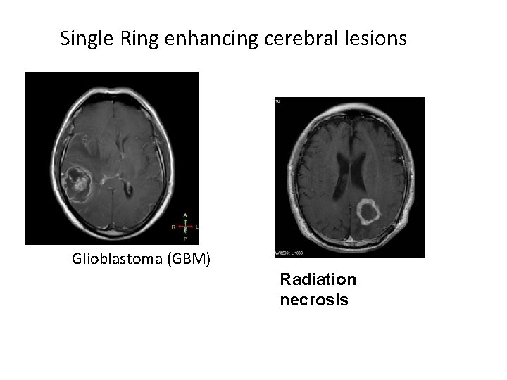 Single Ring enhancing cerebral lesions • Glioblastoma (GBM) Radiation necrosis 