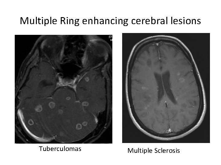Multiple Ring enhancing cerebral lesions Tuberculomas Multiple Sclerosis 