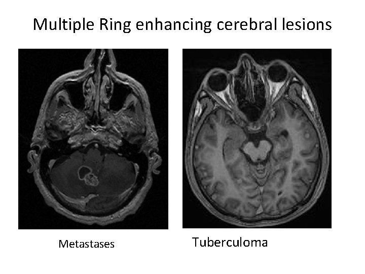 Multiple Ring enhancing cerebral lesions Metastases Tuberculoma 