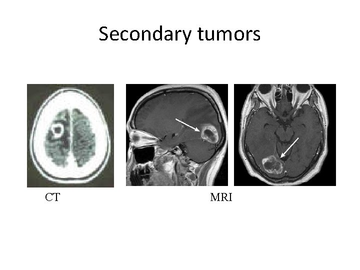 Secondary tumors CT MRI 