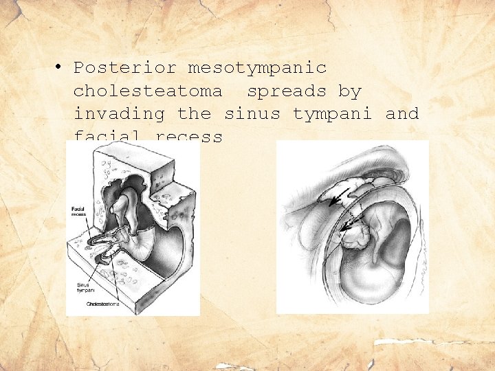  • Posterior mesotympanic cholesteatoma spreads by invading the sinus tympani and facial recess