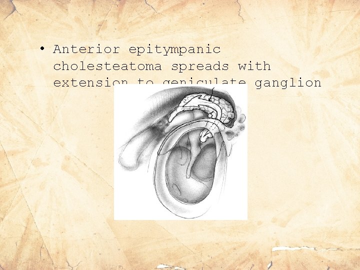  • Anterior epitympanic cholesteatoma spreads with extension to geniculate ganglion 