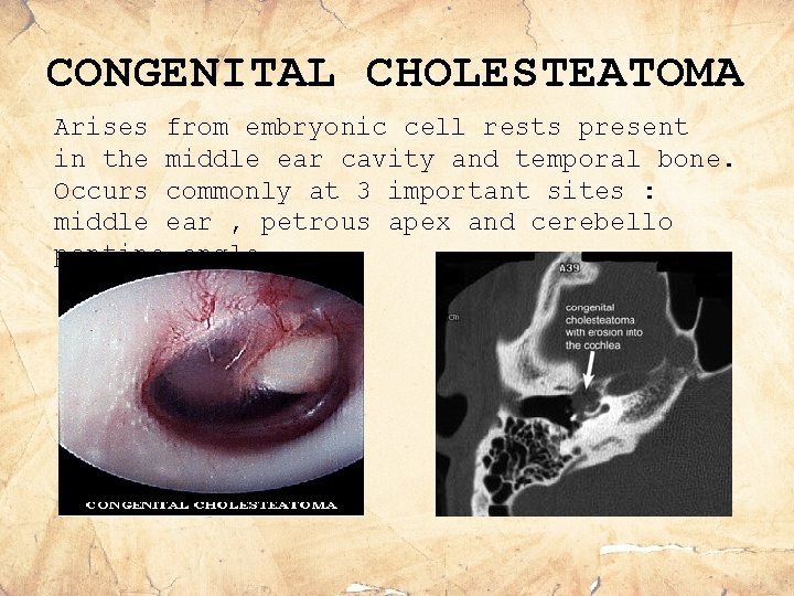 CONGENITAL CHOLESTEATOMA Arises from embryonic cell rests present in the middle ear cavity and