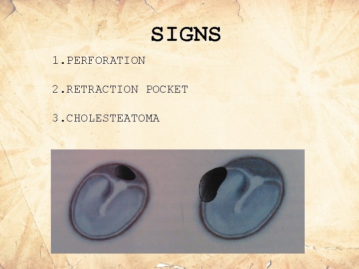 SIGNS 1. PERFORATION 2. RETRACTION POCKET 3. CHOLESTEATOMA 