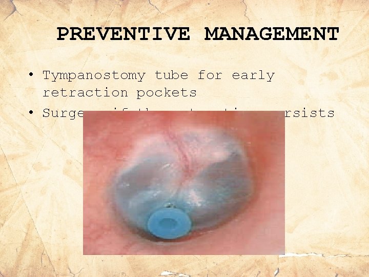 PREVENTIVE MANAGEMENT • Tympanostomy tube for early retraction pockets • Surgery if the retraction