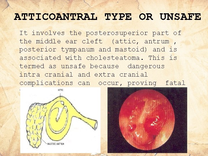 ATTICOANTRAL TYPE OR UNSAFE It involves the posterosuperior part of the middle ear cleft