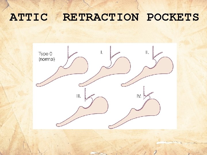 ATTIC RETRACTION POCKETS 