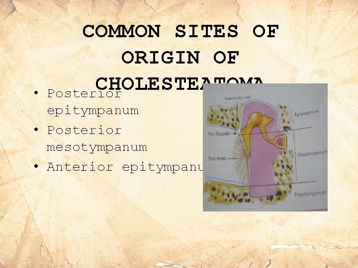  • COMMON SITES OF ORIGIN OF CHOLESTEATOMA Posterior epitympanum • Posterior mesotympanum •