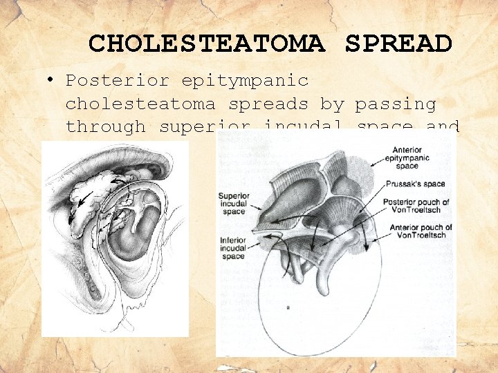 CHOLESTEATOMA SPREAD • Posterior epitympanic cholesteatoma spreads by passing through superior incudal space and