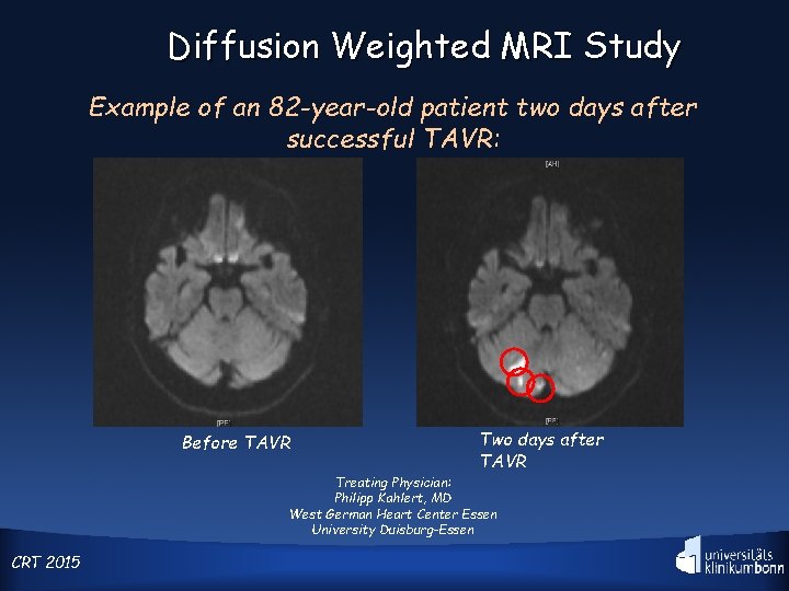 Diffusion Weighted MRI Study Example of an 82 -year-old patient two days after successful