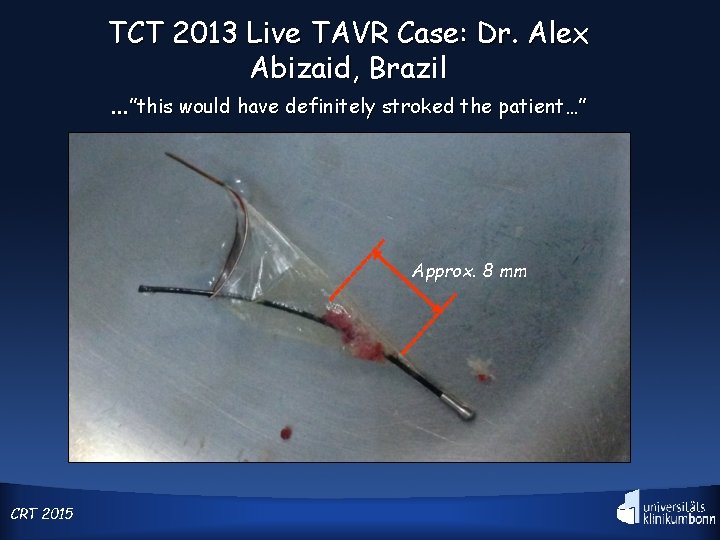 TCT 2013 Live TAVR Case: Dr. Alex Abizaid, Brazil …”this would have definitely stroked