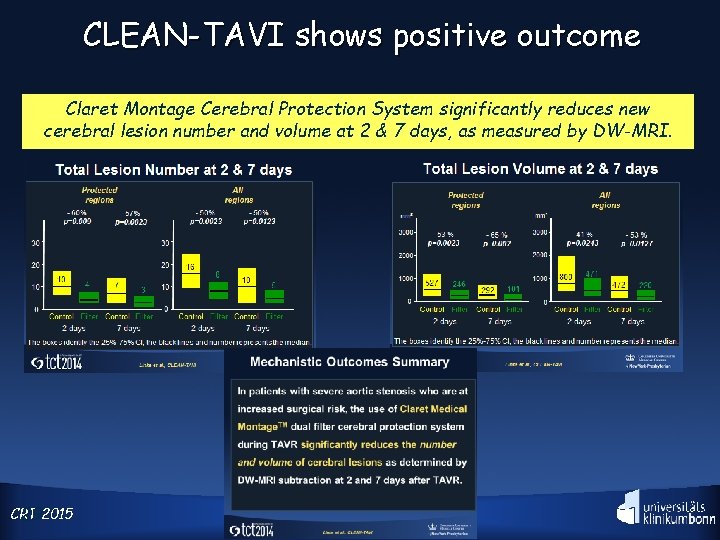 CLEAN-TAVI shows positive outcome Claret Montage Cerebral Protection System significantly reduces new cerebral lesion